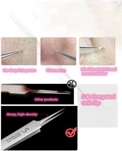 🔥HOT SALE - Professional Facial Blackhead Remover Tweezers