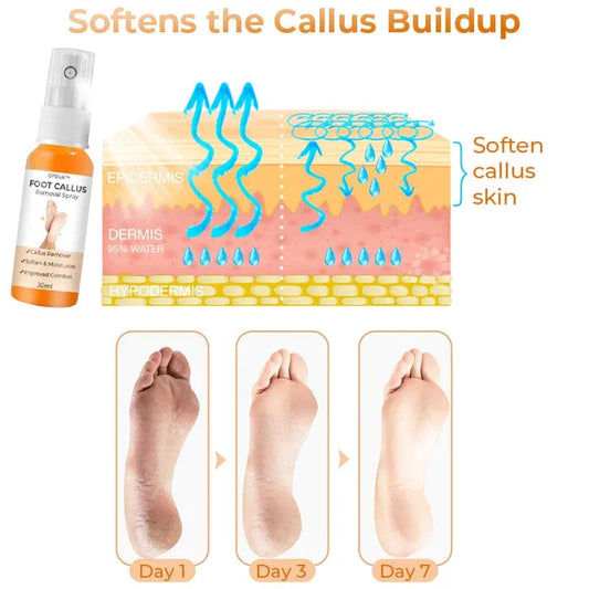 (Limited Time Discount 🔥 Last Day 70% Off) GFOUK™ Foot Callus Removal Spray