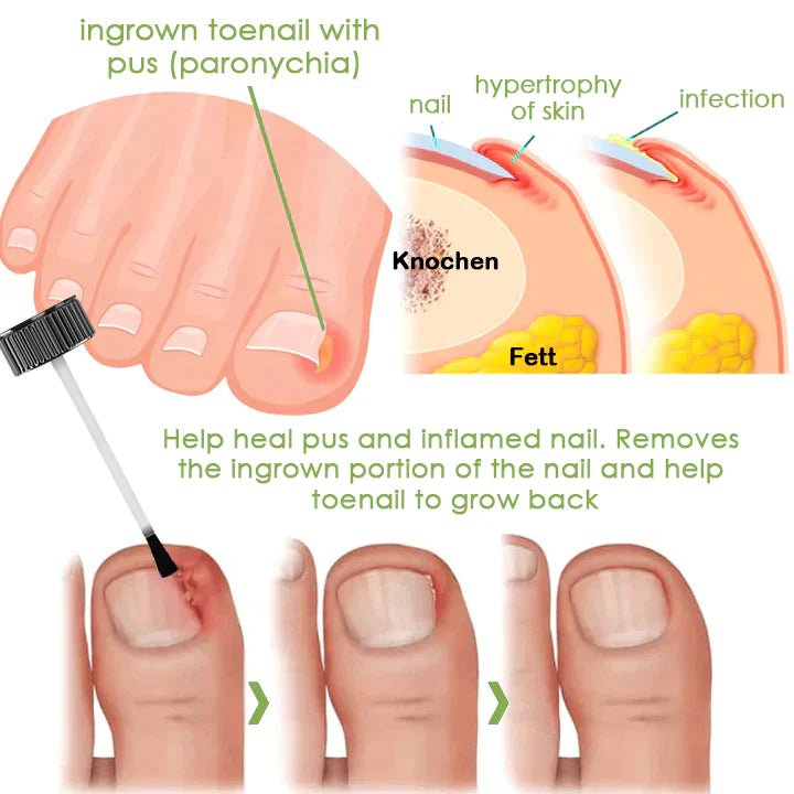 Voilaist™ Removal Paronychia Gel (Fungal infections, ingrown nail, discolored or damaged nails)🔥(Limited time discount Last 30 minutes)