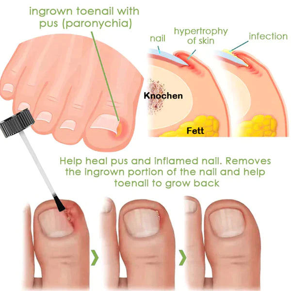 Fivfivgo™ FootCure Gel zur Entfernung von Paronychie